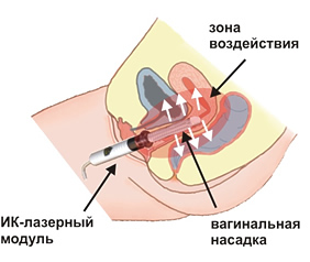 Вагинальная методика лечения кольпита, аднексита.