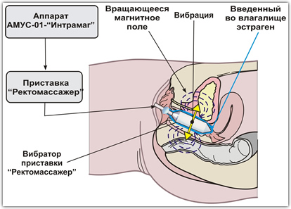 Второй этап лечения - вагинальный вибромагнитный массаж в присутствии крема 
