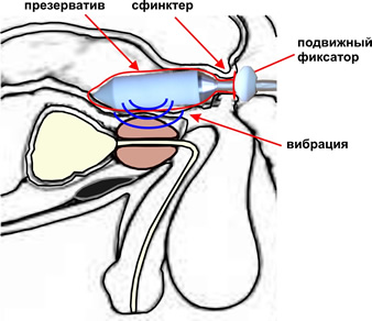 Расположение инструмента-вибратора в прямой кишке при проведении процедуры вибромассажа с помо-щью приставки "РЕКТОМАССАЖЕР".